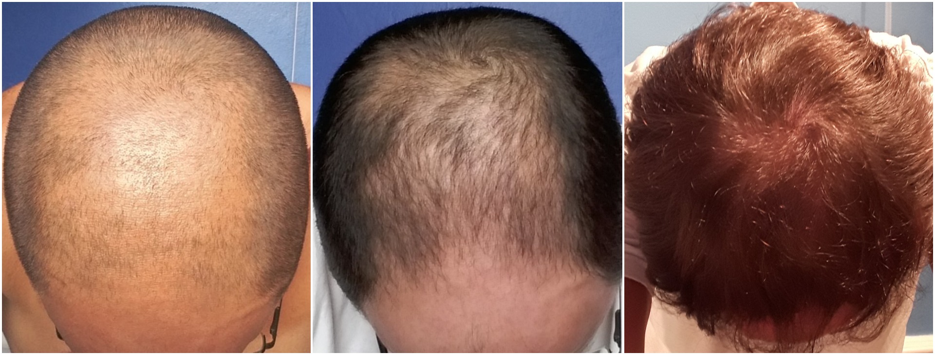 Hair restoration is working – it’s official!